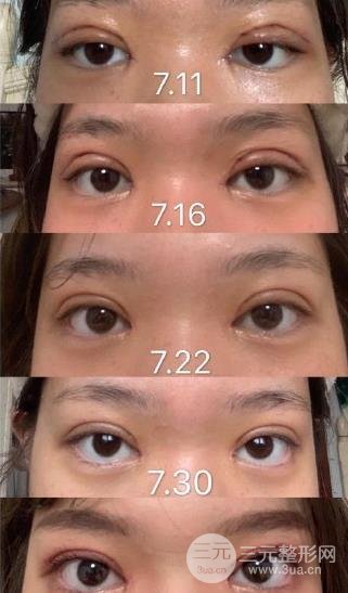 雙眼皮全切過(guò)程是怎樣的