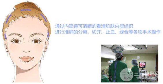 小切口除皺術(shù)果怎么樣