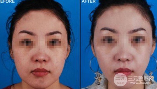 圓臉怎樣變瓜子臉