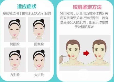 咬肌注射瘦臉