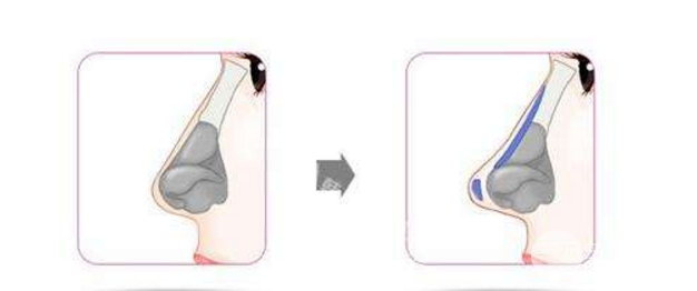 塌鼻子想要變美？教你一招怎樣墊高鼻梁！