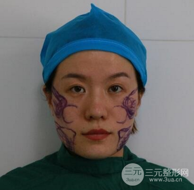 面部溶脂前后對比照片