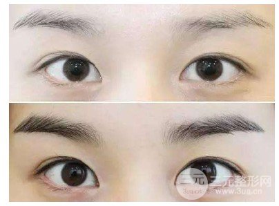 眉部整形有哪些方式