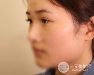 開(kāi)眼角前后對(duì)比照片