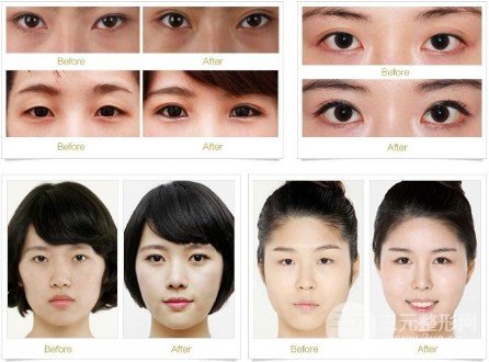開(kāi)眼角前后對(duì)比照片