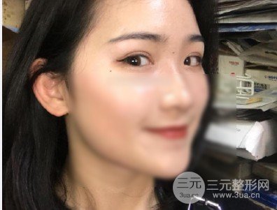 開(kāi)眼角前后對(duì)比照片