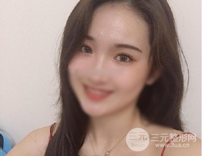 開(kāi)眼角前后對(duì)比照片