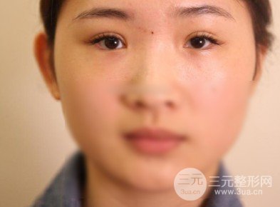 開(kāi)眼角前后對(duì)比照片