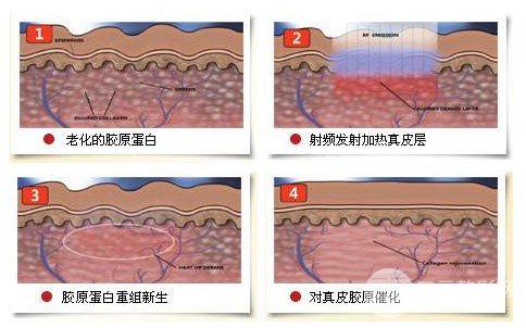 激光緩解黑眼圈有沒有副作用