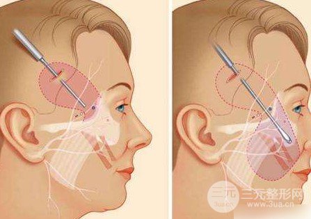 小切口除皺術(shù)的危害