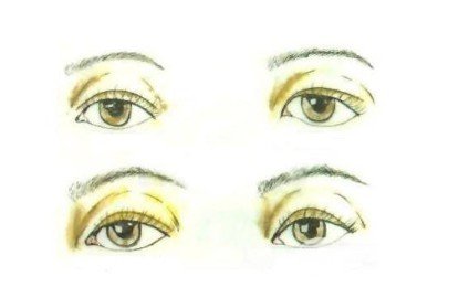 雙眼皮全切過程