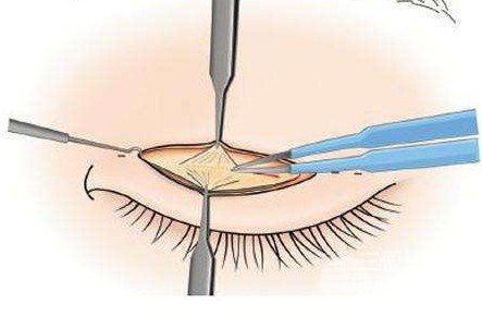雙眼皮全切過程