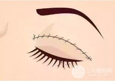 雙眼皮全切過程