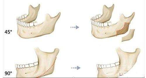 磨下頜骨要多少錢