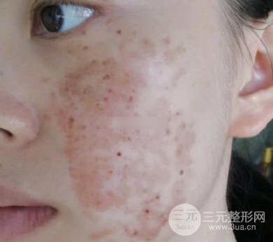 激光能治黃褐斑嗎