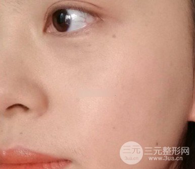 激光能治黃褐斑嗎