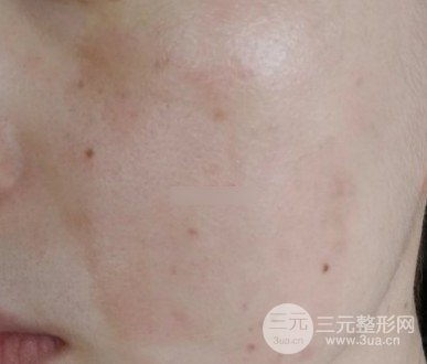 黃褐斑緩解費(fèi)用高不高