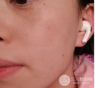 黃褐斑緩解費(fèi)用高不高