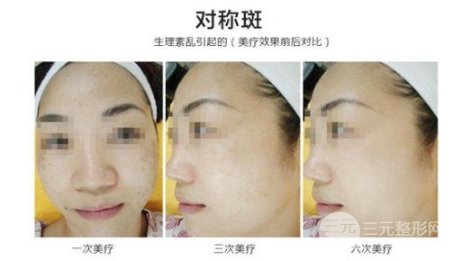 激光祛斑需要多少錢