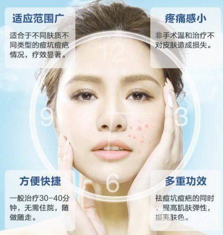 激光緩解痤瘡大概多少錢