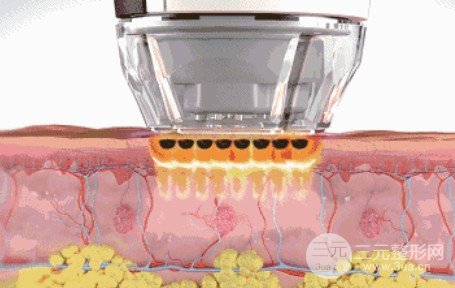 光子嫩膚黃褐斑原理