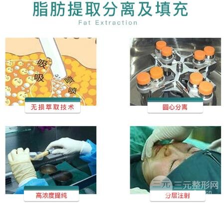 脂肪填充眼窩的特點