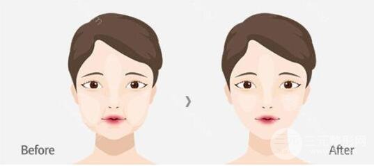 去頰脂墊手術(shù)后的恢復(fù)