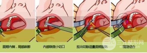 去頰脂墊手術(shù)后的恢復(fù)