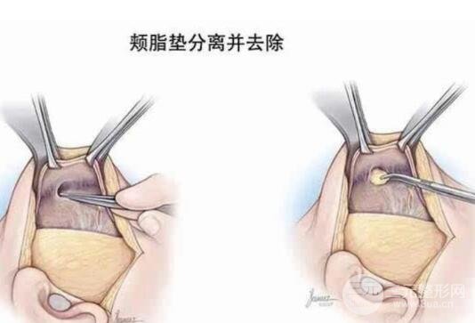 去頰脂墊手術(shù)的副作用