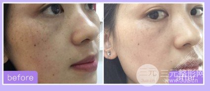 激光可以去除黃褐斑嗎