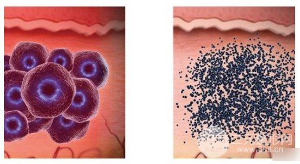 激光祛黃褐斑會越來越嚴重