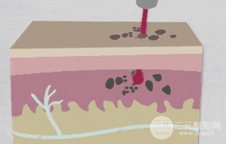 激光祛黃褐斑會反彈嗎