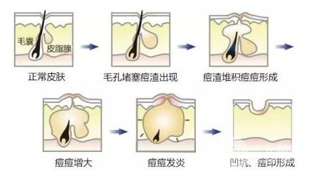 激光緩解痤瘡果怎么樣