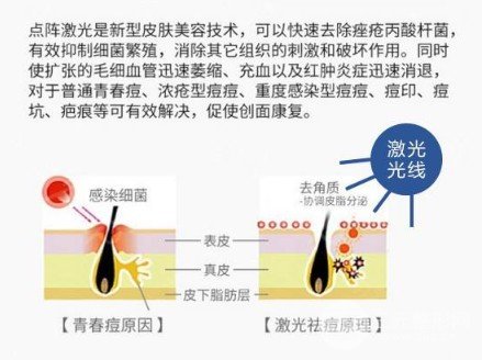 激光緩解痤瘡會(huì)復(fù)發(fā)嗎