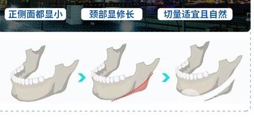 磨下頜角手術案例合集，磨骨手術科普~