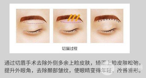 切眉除皺和注射除皺