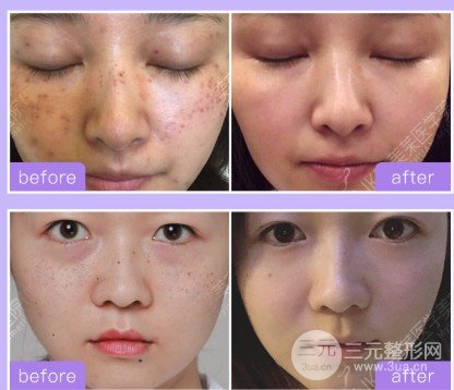 激光祛黃褐斑幾次能看到果
