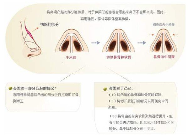 駝峰鼻整形費(fèi)用貴嗎