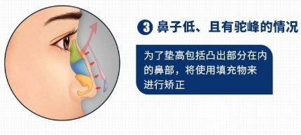 駝峰鼻整形費(fèi)用貴嗎