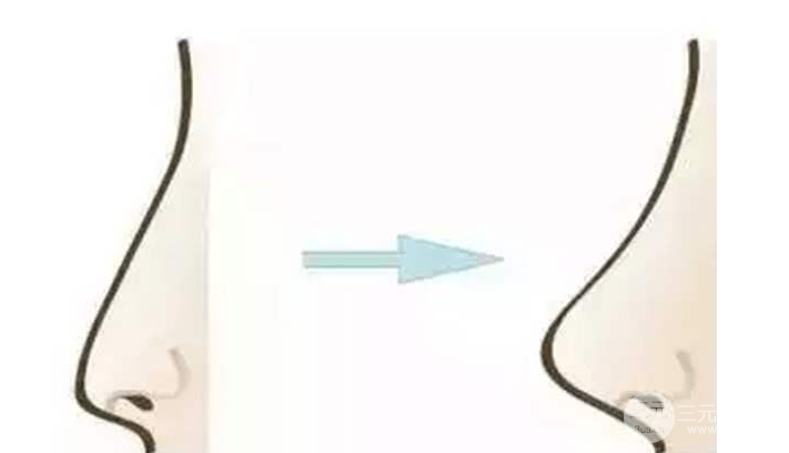 隆鼻假體壽命有多長(zhǎng)