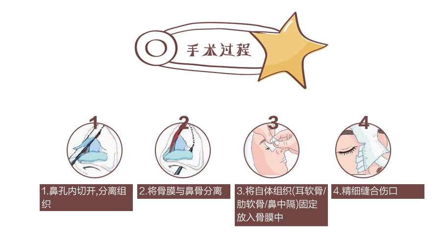 隆鼻假體壽命有多長(zhǎng)