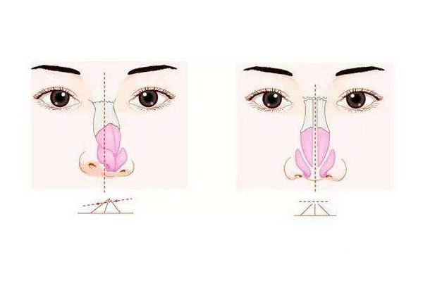 隆鼻假體壽命有多長(zhǎng)