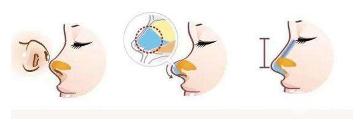 鼻頭塑形是什么項目