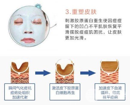 光子緩解痤瘡需要幾次