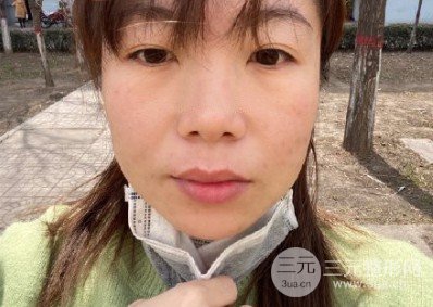 光子嫩膚祛痘印果