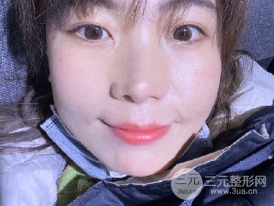 光子嫩膚祛痘印果