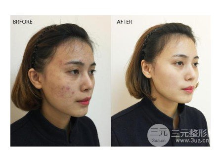 彩光嫩膚祛痘印好嗎