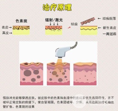 彩光嫩膚祛痘印好嗎