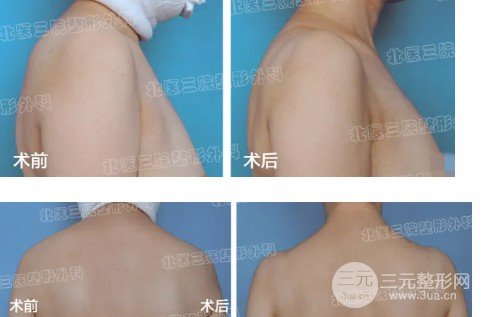 吸脂減肥價(jià)格貴不貴