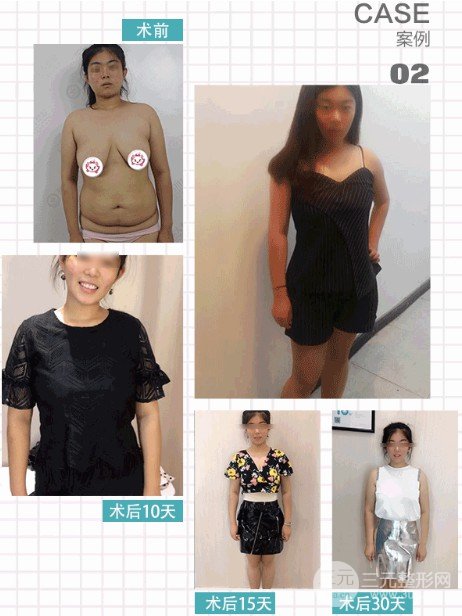 吸脂減肥價(jià)格貴不貴